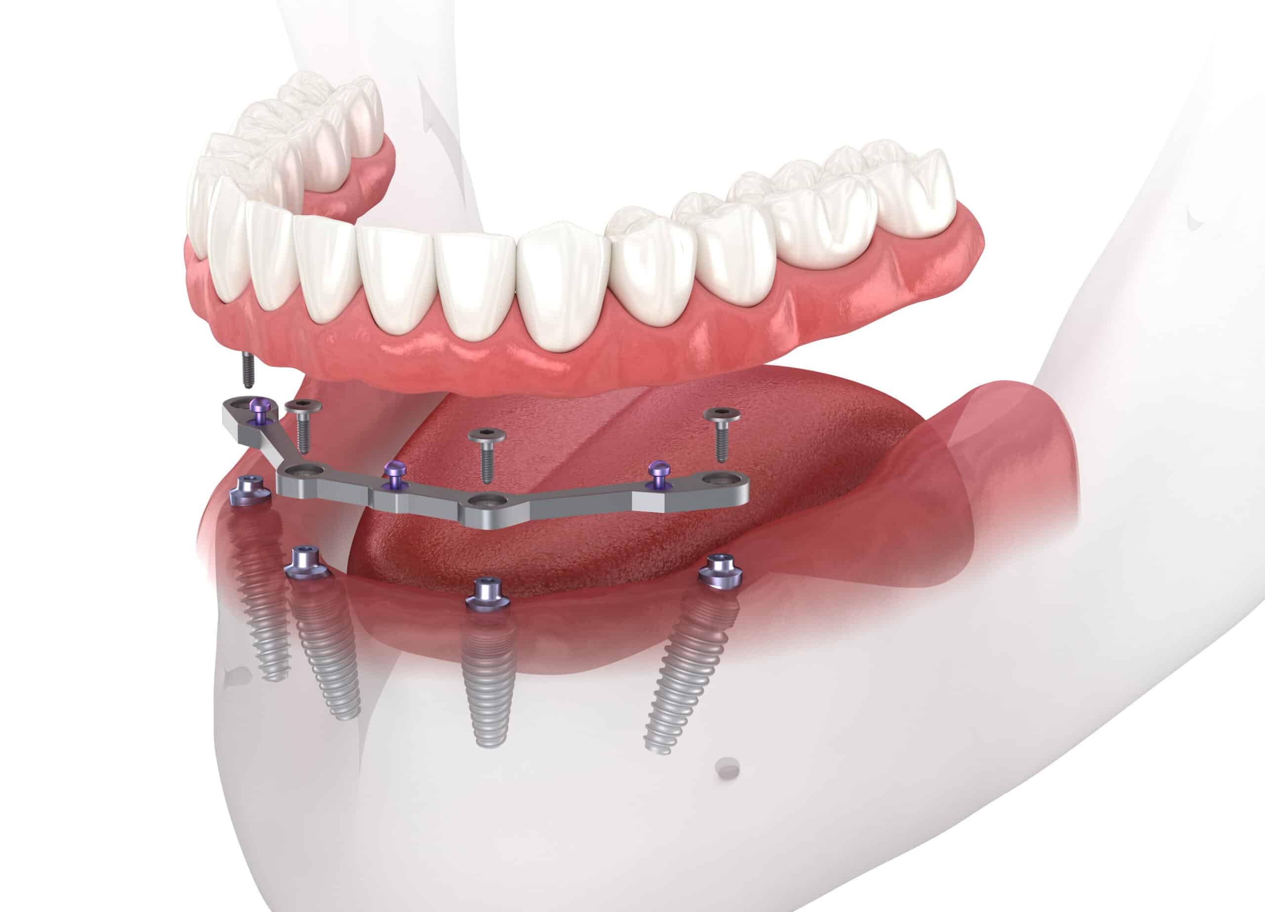implanty zębów turek